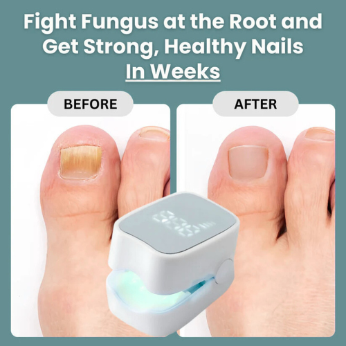 Gadgets™ - Nail Fungus Laser Device