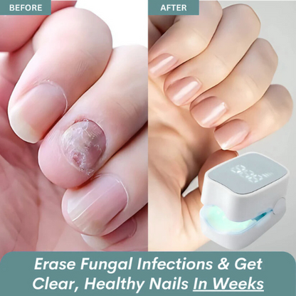 Gadgets™ - Nail Fungus Laser Device