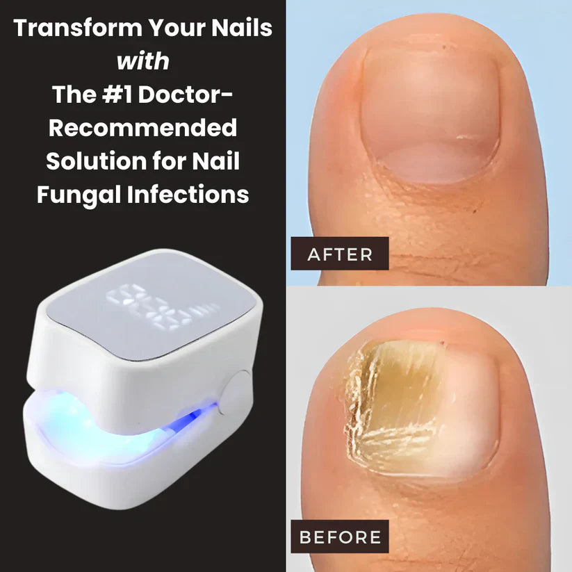 Gadgets™ - Nail Fungus Laser Device